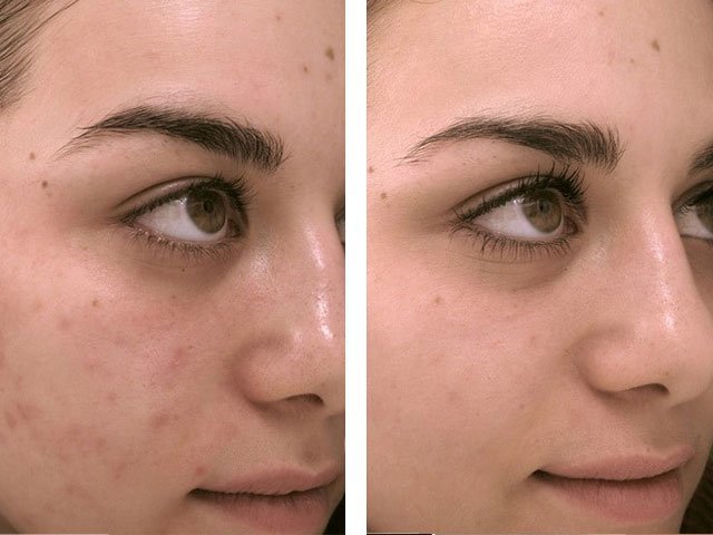 Ультразвуковая чистка лица результат 2